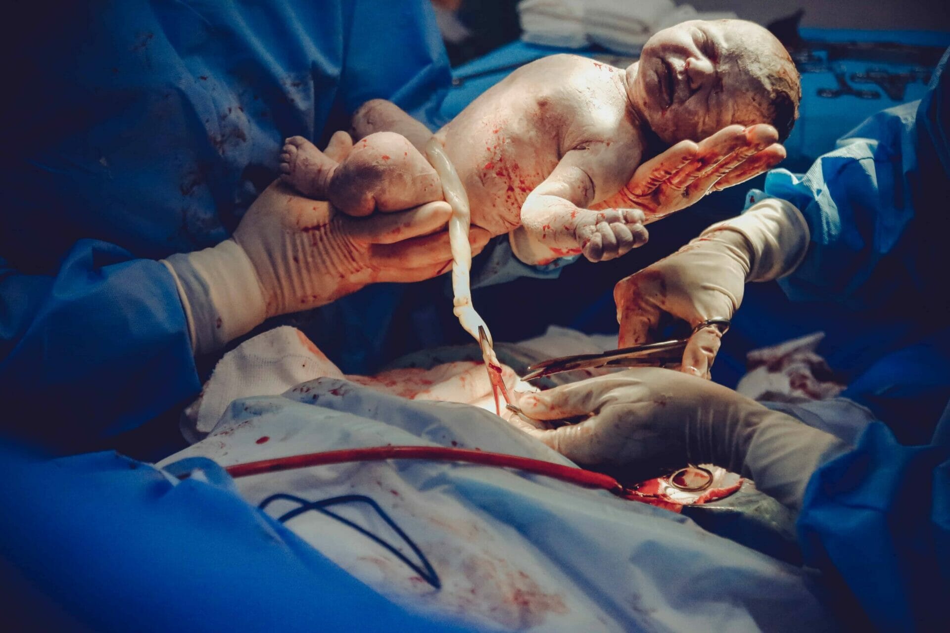 Having a Cesarean